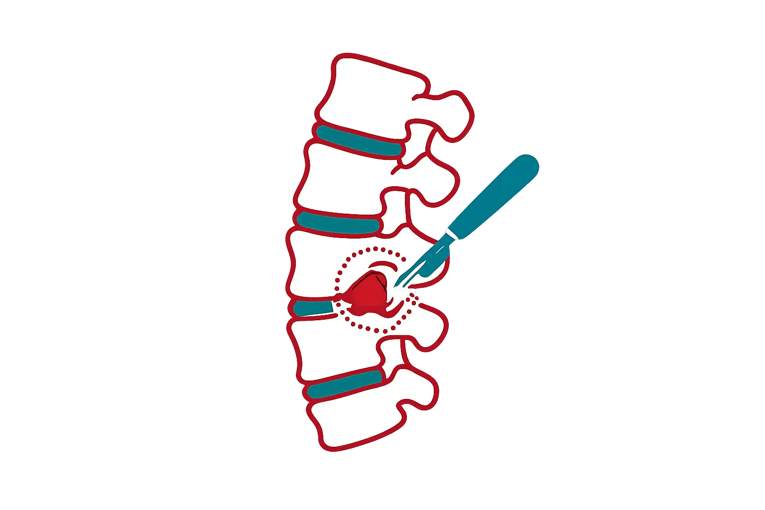 Illustration of stacked lumbar vertebrae with a needle injecting into a disc, highlighting the pain area in red.